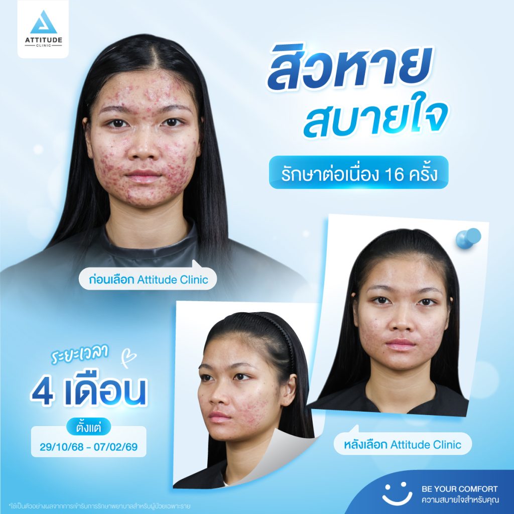 รักษาสิว