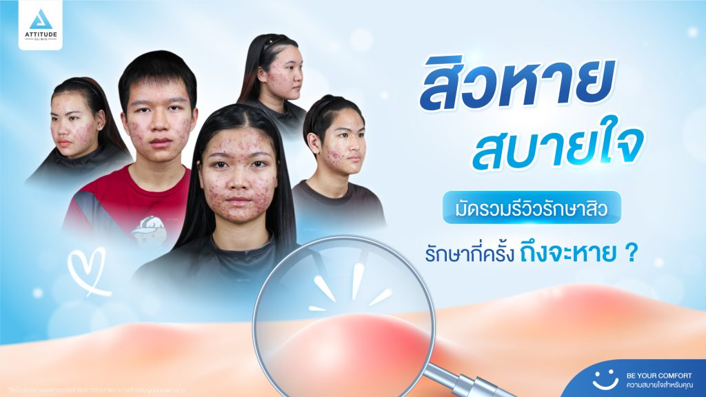 รักษาสิว