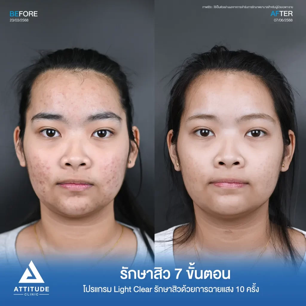 รีวิวรักษาสิวพี่เฟย์ ด้วยโปรแกรม Light Clear จำนวน 10 ครั้ง ที่ Attitude Clinic