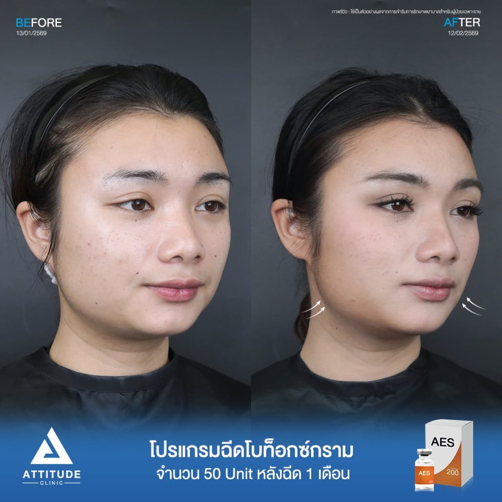 รีวิวโปรแกรมฉีดโบท็อกซ์พี่แบม AES จำนวน 50 ยูนิต หลังทำ 1 เดือน ลดกราม ปรับรูปหน้าที่ ATTITUDE CLINIC