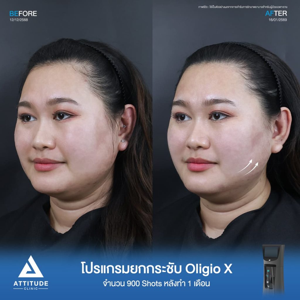 รีวิวโปรแกรมยกกระชับ Oligio X ของพี่ต้อม จำนวน 400 shot หลังทำ 30 นาที แก้ปัญหาผิวหย่อนคล้อยแบบไม่ทำให้ผิวระคายเคืองที่ ATTITUDE CLINIC