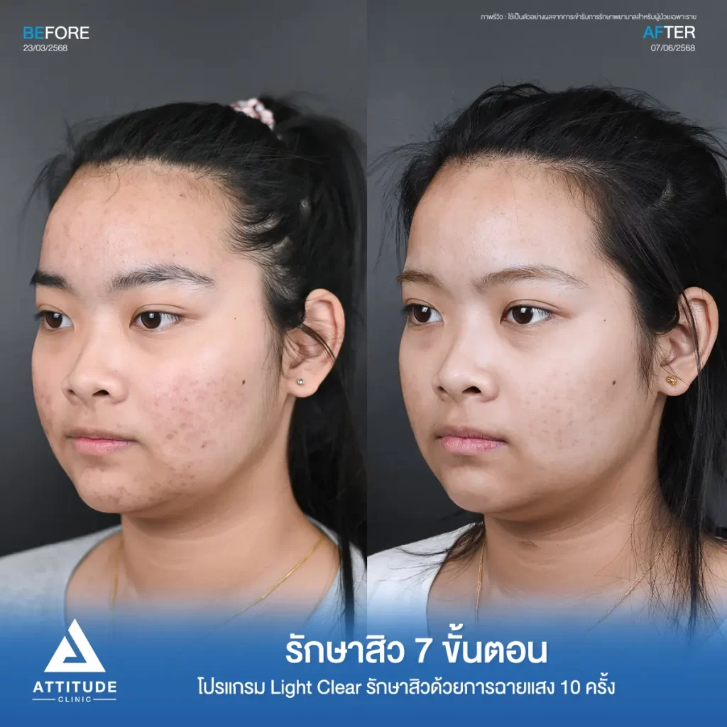 รีวิวรักษาสิวพี่เฟย์ ด้วยโปรแกรม Light Clear จำนวน 10 ครั้ง ที่ Attitude Clinic