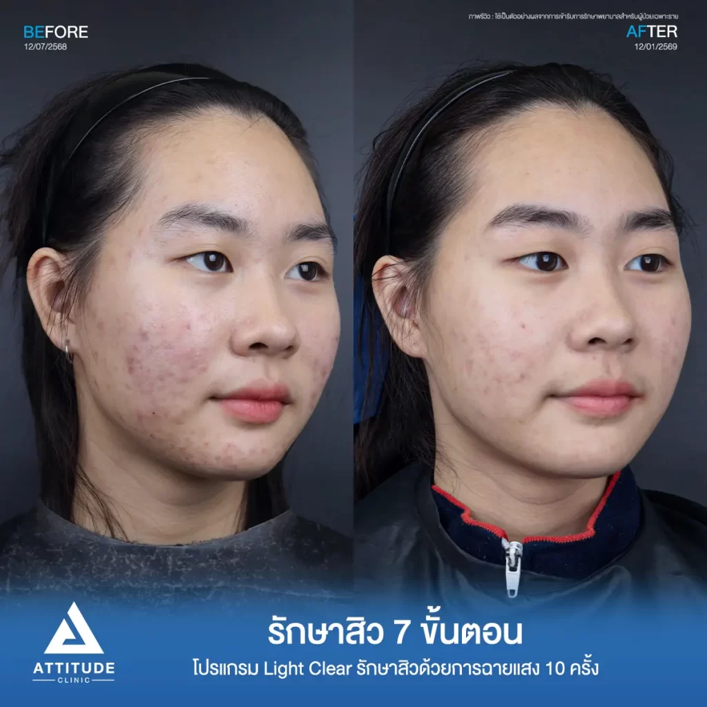 รีวิวรักษาสิวเอิร์น โปรแกรม Light Clear รักษาสิวด้วยการฉายแสง จำนวน 10 ครั้งที่ Attitude Clinic