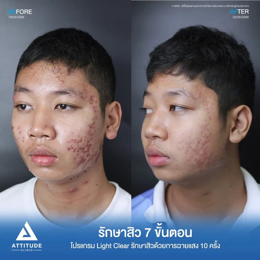 รีวิวรักษาสิวซี โปรแกรม Light Clear รักษาสิวด้วยการฉายแสง จำนวน 10 ครั้งที่ Attitude Clinic