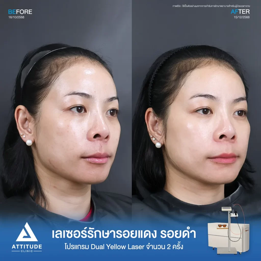 รีวิวโปรแกรม Dual Yellow Laser พี่เปิ้ล รักษารอยดำ ฝ้า กระ ที่ ATTITUDE CLINIC