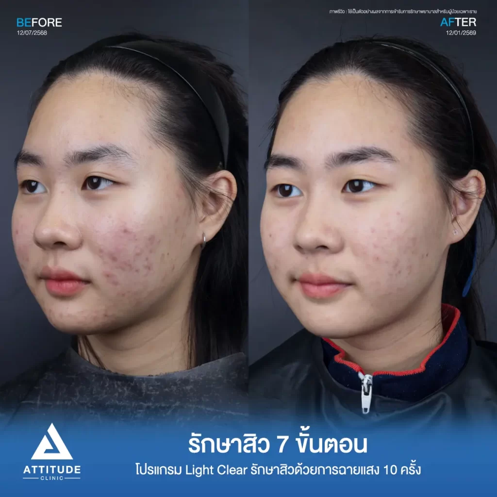 รีวิวรักษาสิวเอิร์น โปรแกรม Light Clear รักษาสิวด้วยการฉายแสง จำนวน 10 ครั้งที่ Attitude Clinic