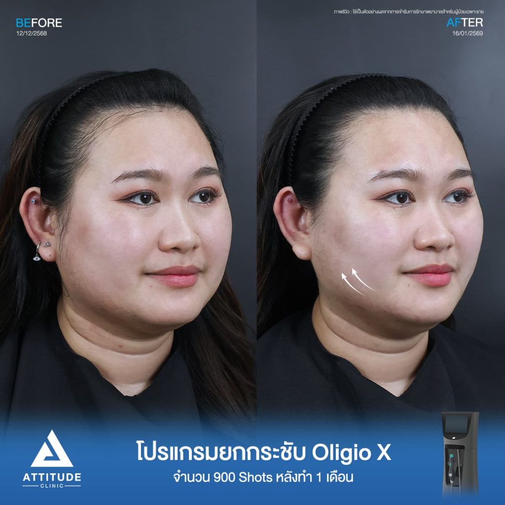 รีวิวโปรแกรมยกกระชับ Oligio X ของพี่ต้อม จำนวน 400 shot หลังทำ 30 นาที แก้ปัญหาผิวหย่อนคล้อยแบบไม่ทำให้ผิวระคายเคืองที่ ATTITUDE CLINIC