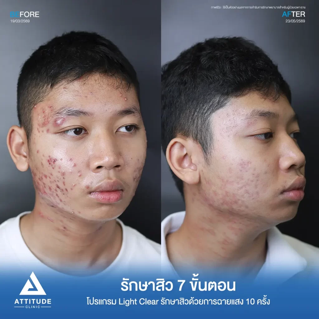 รีวิวรักษาสิวซี โปรแกรม Light Clear รักษาสิวด้วยการฉายแสง จำนวน 10 ครั้งที่ Attitude Clinic