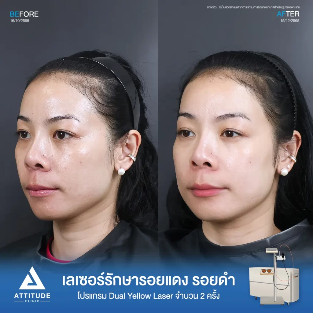 รีวิวโปรแกรม Dual Yellow Laser พี่เปิ้ล รักษารอยดำ ฝ้า กระ ที่ ATTITUDE CLINIC