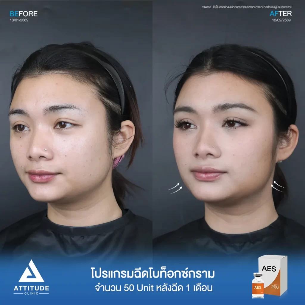 รีวิวโปรแกรมฉีดโบท็อกซ์พี่แบม AES จำนวน 50 ยูนิต หลังทำ 1 เดือน ลดกราม ปรับรูปหน้าที่ ATTITUDE CLINIC