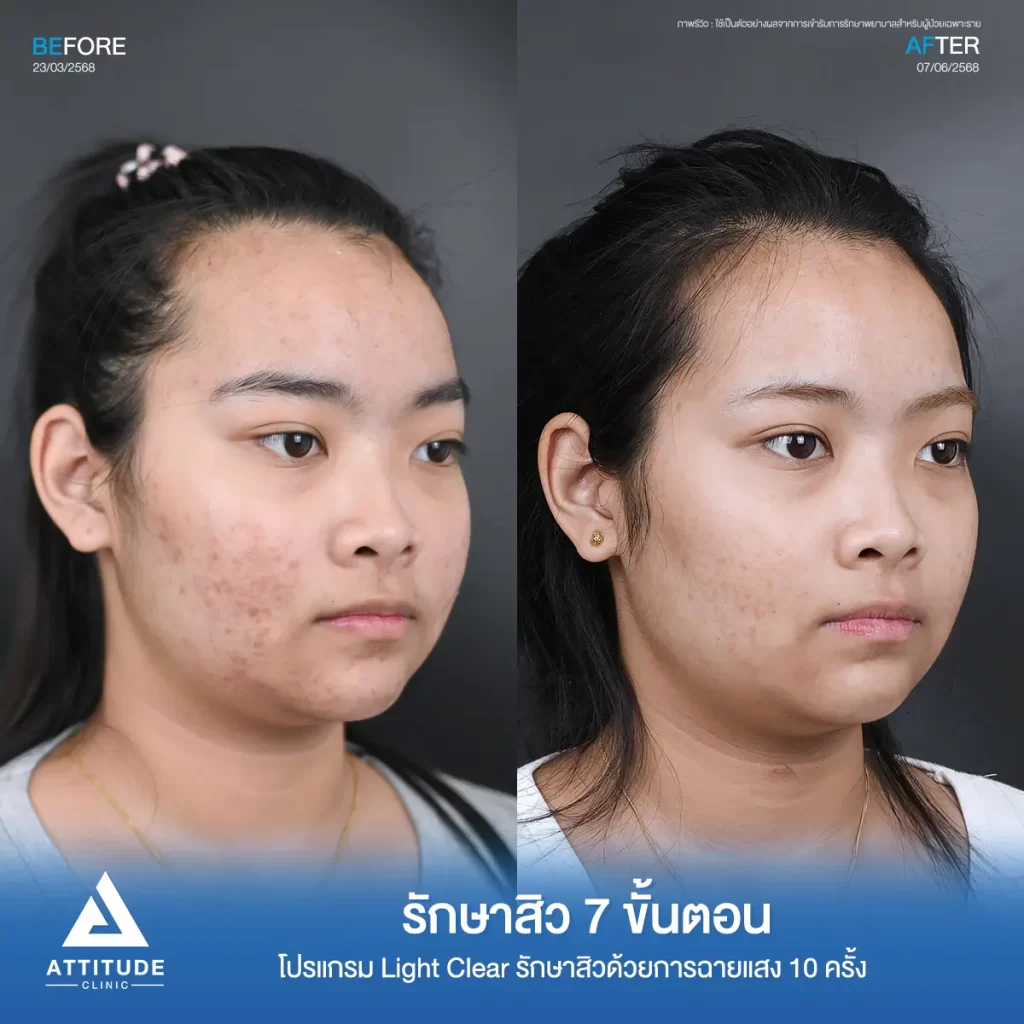 รีวิวรักษาสิวพี่เฟย์ ด้วยโปรแกรม Light Clear จำนวน 10 ครั้ง ที่ Attitude Clinic