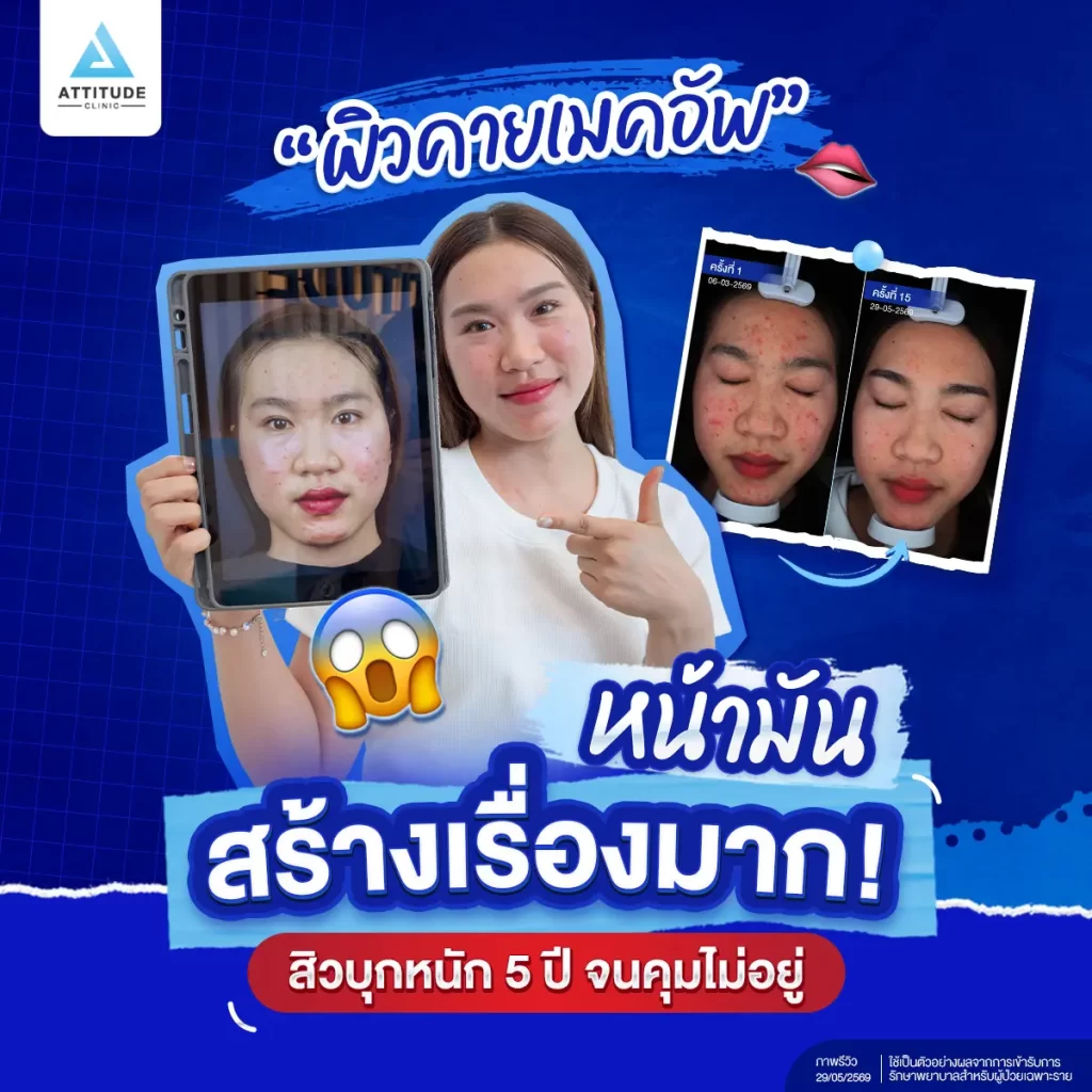 รีวิวรักษาสิวพี่โดนัท - สิวบุก จนเมคอัพเอาไม่อยู่! เคสผิวมันขนาดนี้ รักษาให้หายได้จริงเหรอ !?
