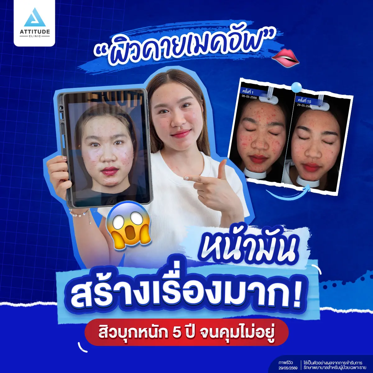 รีวิวรักษาสิวพี่โดนัท - สิวบุก จนเมคอัพเอาไม่อยู่! เคสผิวมันขนาดนี้ รักษาให้หายได้จริงเหรอ !?