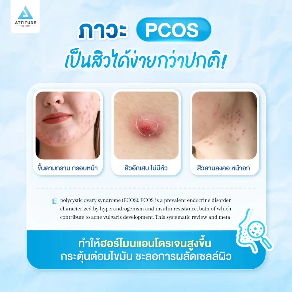 สาวๆ ต้องระวัง! สิวเรื้อรัง เป็นๆ หายๆ สัญญาณเตือนภาวะฮอร์โมนผิดปกติ