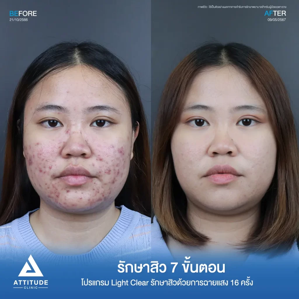 รวมรีวิวรักษาสิวอักเสบ ที่หลายคนเคยคิดว่า... "สิวแบบนี้รักษายาก"