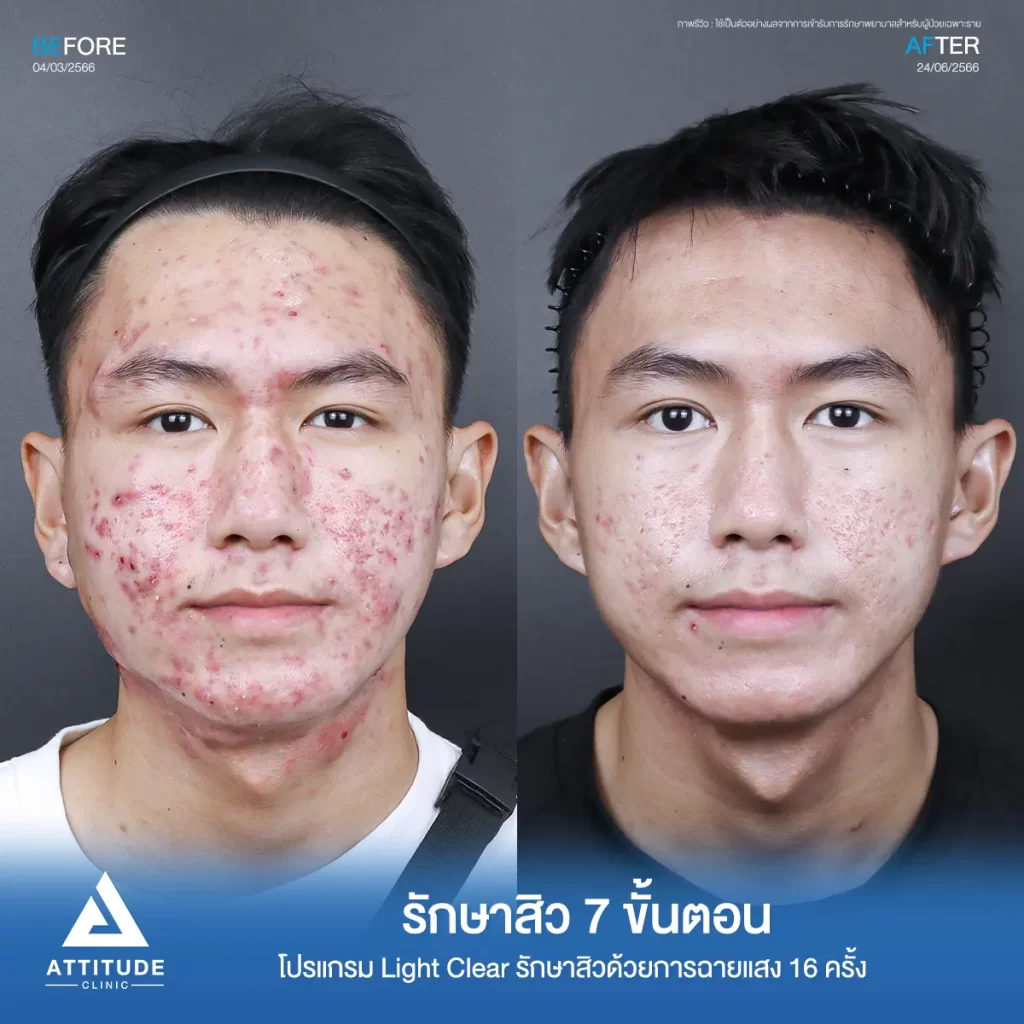รวมรีวิวรักษาสิวอักเสบ ที่หลายคนเคยคิดว่า... "สิวแบบนี้รักษายาก"