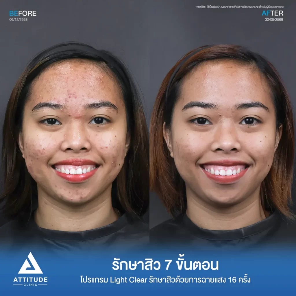 รีวิวรักษาสิวพี่โนนา ด้วยโปรแกรม Light Clear จำนวน 16 ครั้ง ที่ Attitude Clinic