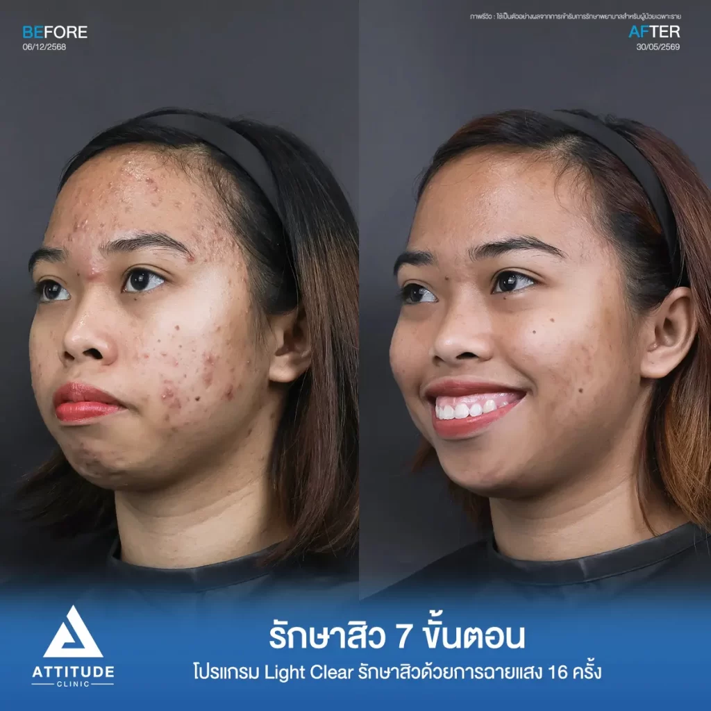 รีวิวรักษาสิวพี่โนนา ด้วยโปรแกรม Light Clear จำนวน 16 ครั้ง ที่ Attitude Clinic