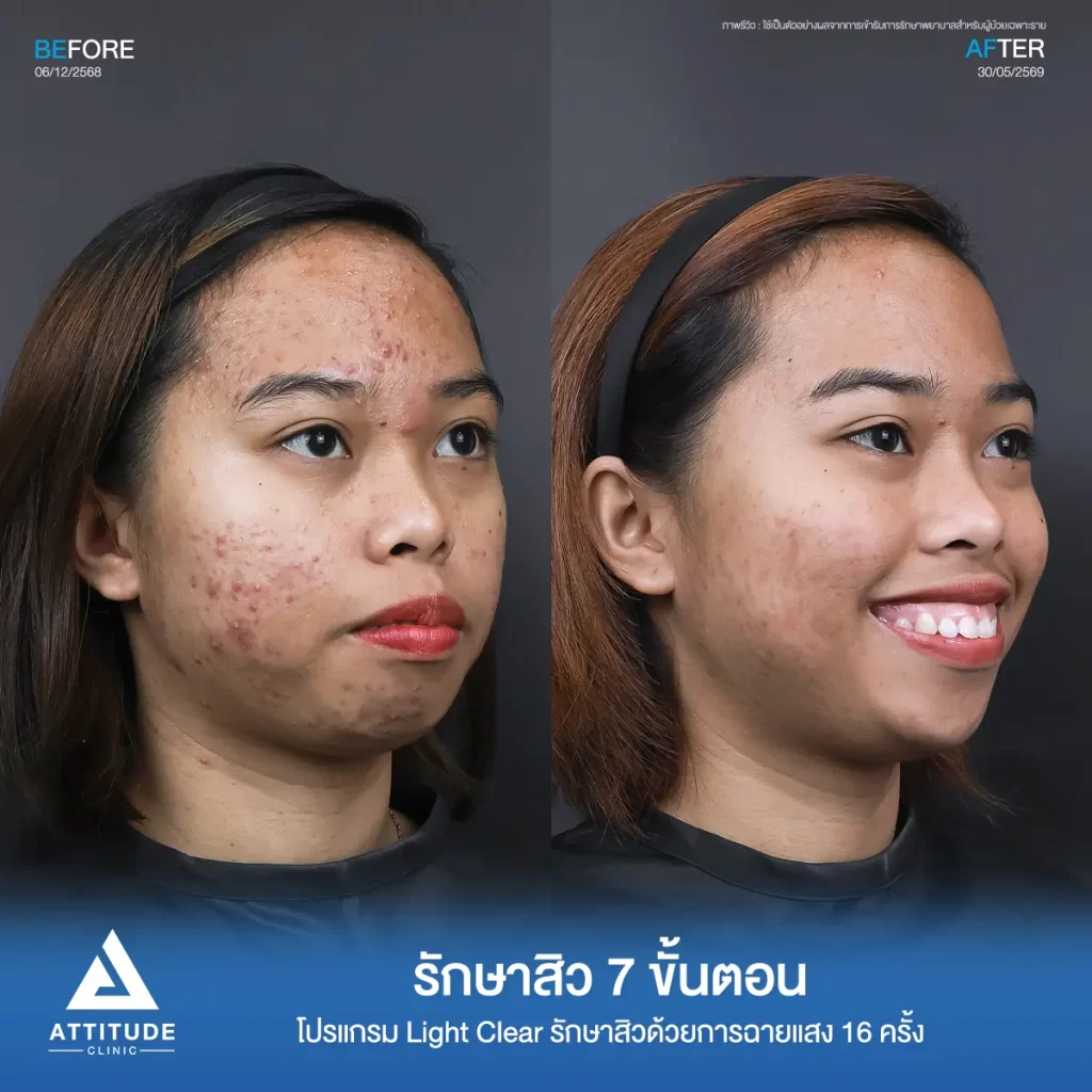 รีวิวรักษาสิวพี่โนนา ด้วยโปรแกรม Light Clear จำนวน 16 ครั้ง ที่ Attitude Clinic