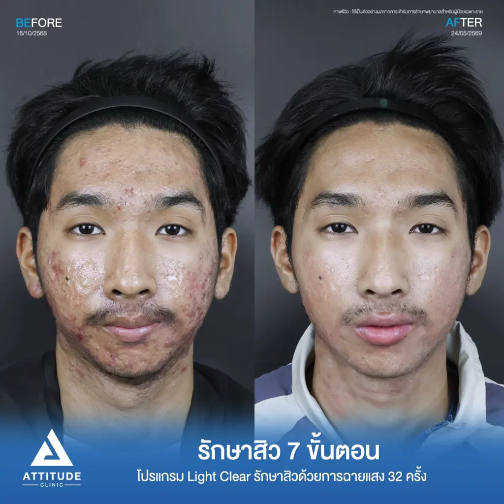 รีวิวรักษาสิวเอ็ม โปรแกรม Light Clear รักษาสิวด้วยการฉายแสง จำนวน 32 ครั้งที่ Attitude Clinic