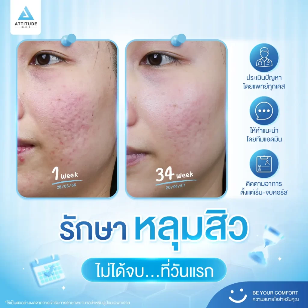 รักษาหลุมสิว ไม่ได้รักษาจบแค่วันเดียว !!
