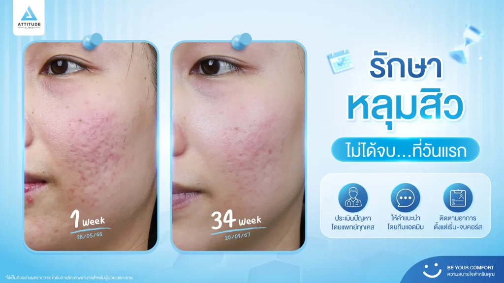 รักษาหลุมสิว ไม่ได้รักษาจบแค่วันเดียว !!