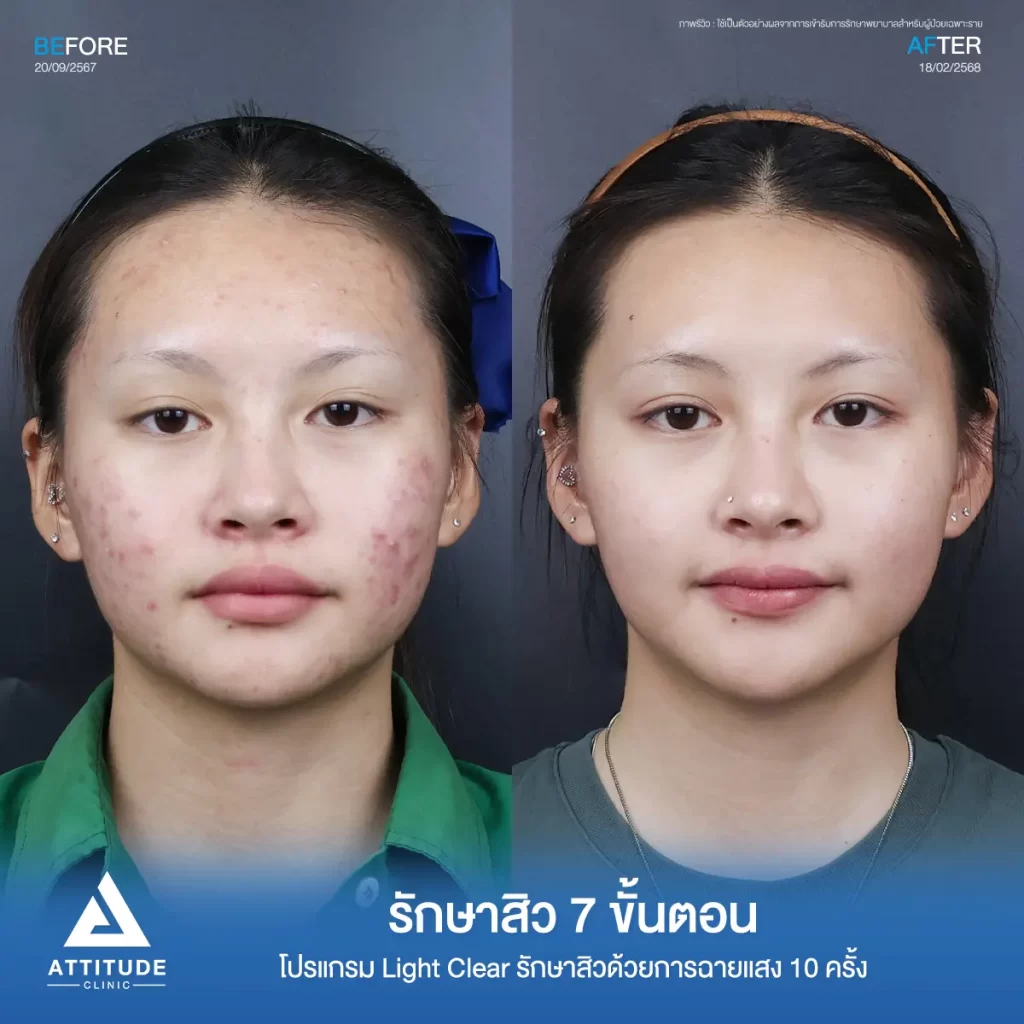 รวมรีวิวรักษาสิวอักเสบ ที่หลายคนเคยคิดว่า... "สิวแบบนี้รักษายาก"