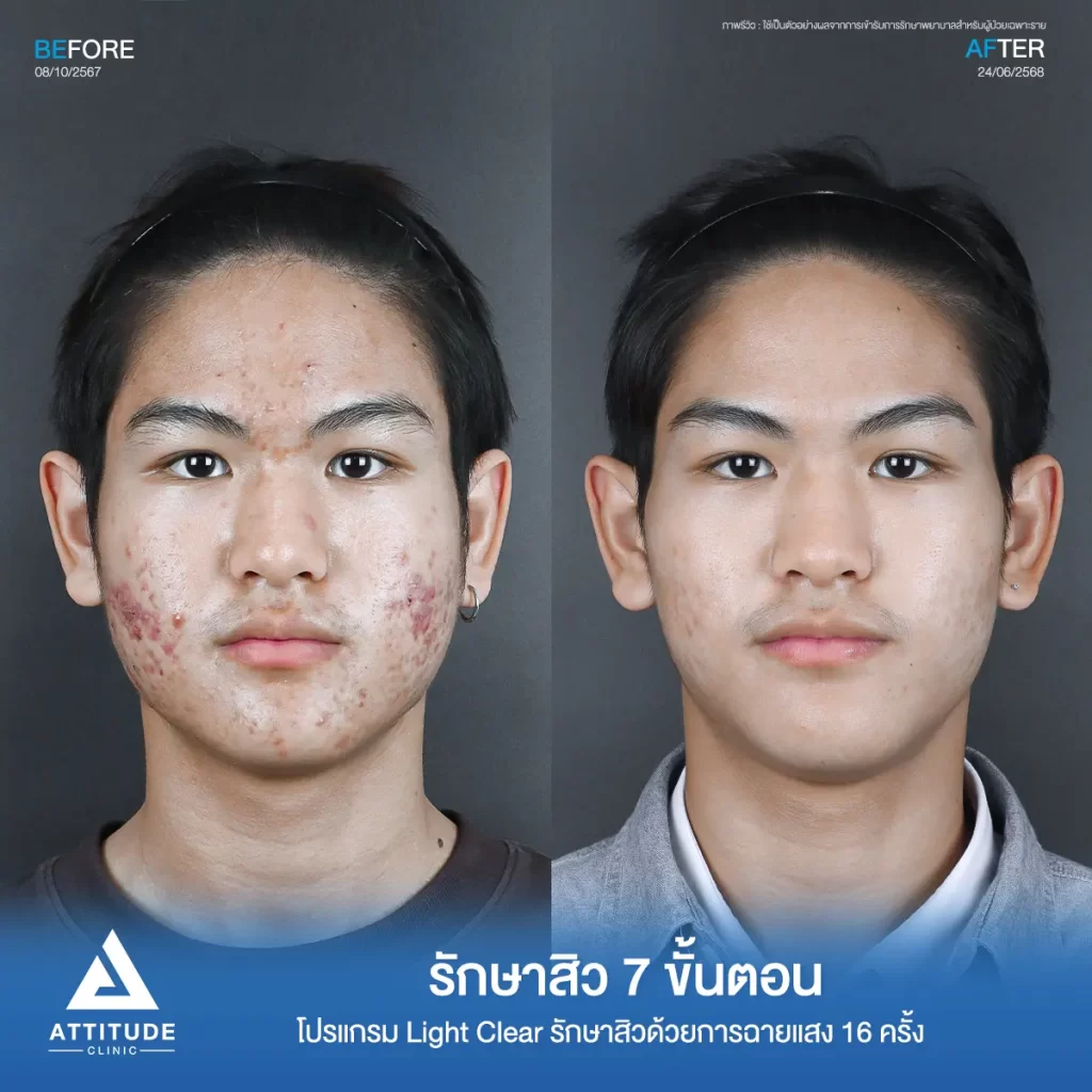 รวมรีวิวรักษาสิวอักเสบ ที่หลายคนเคยคิดว่า... "สิวแบบนี้รักษายาก"
