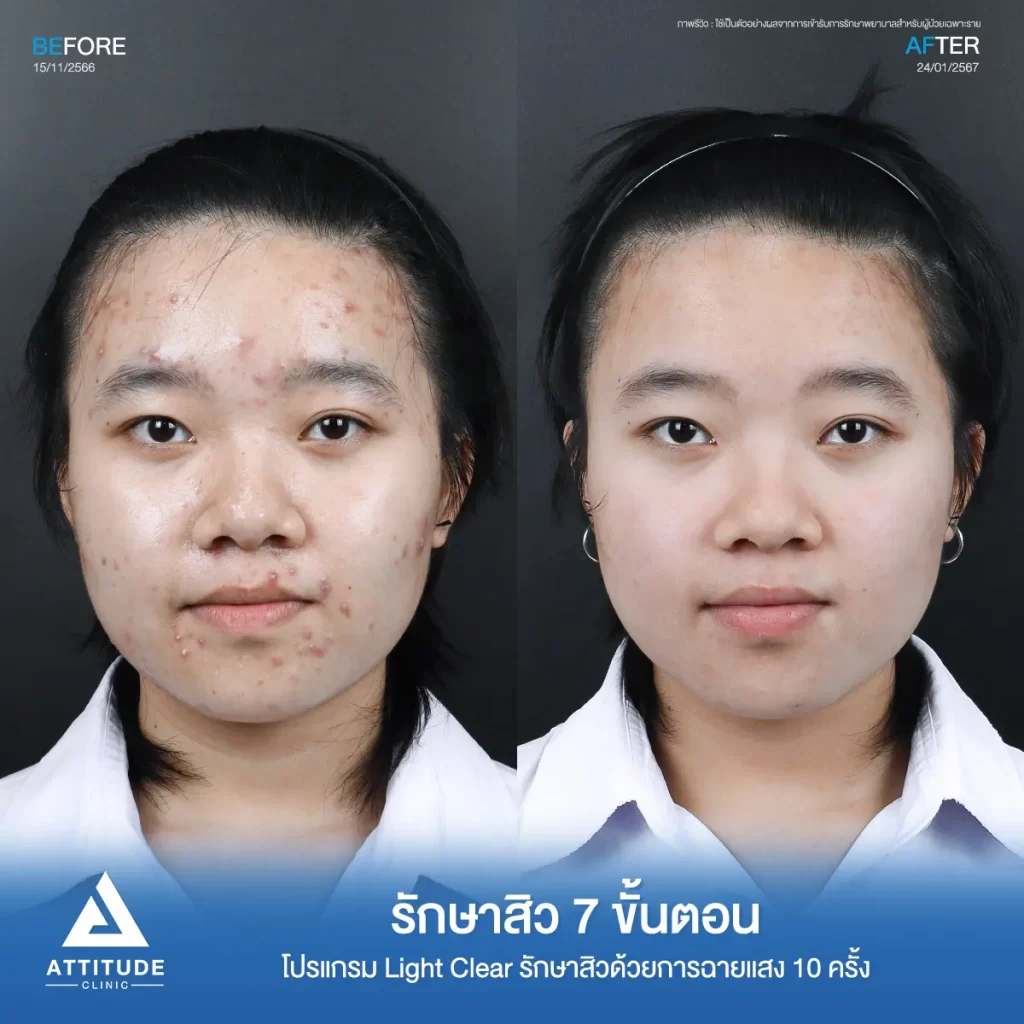 รวมรีวิวรักษาสิวอักเสบ ที่หลายคนเคยคิดว่า... "สิวแบบนี้รักษายาก"