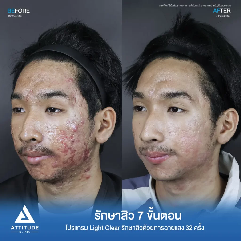 รีวิวรักษาสิวเอ็ม โปรแกรม Light Clear รักษาสิวด้วยการฉายแสง จำนวน 31 ครั้งที่ Attitude Clinic