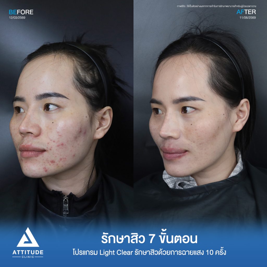 รีวิวรักษาสิวปิ่น โปรแกรม Light Clear รักษาสิวด้วยการฉายแสง จำนวน 10 ครั้งที่ Attitude Clinic