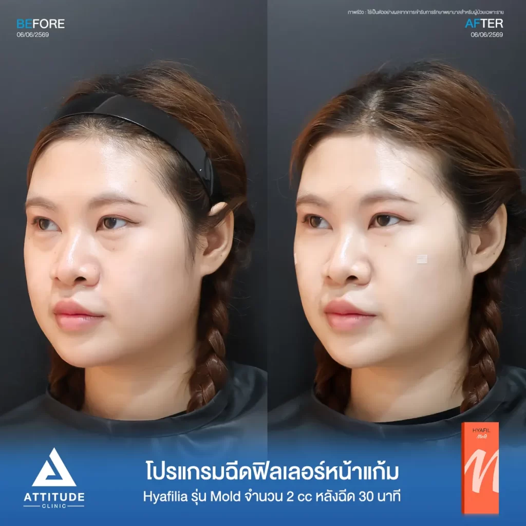 รีวิวโปรแกรมฉีดฟิลเลอร์หน้าแก้มพี่อิ๋ม Hya รุ่น Mold จำนวน 2 cc หลังทำ 30 นาที เติมเต็มใต้ตาให้สดใส ที่ ATTITUDE CLINIC