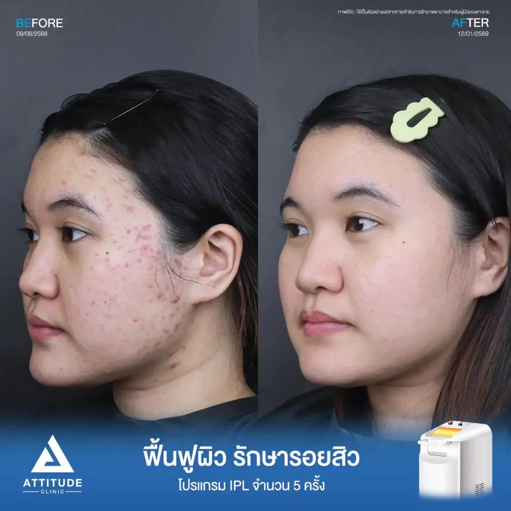 รีวิวรักษารอยสิวพี่พิมพ์ ด้วยโปรแกรม IPL จำนวน 5 ครั้ง ที่ ATTITUDE CLINIC