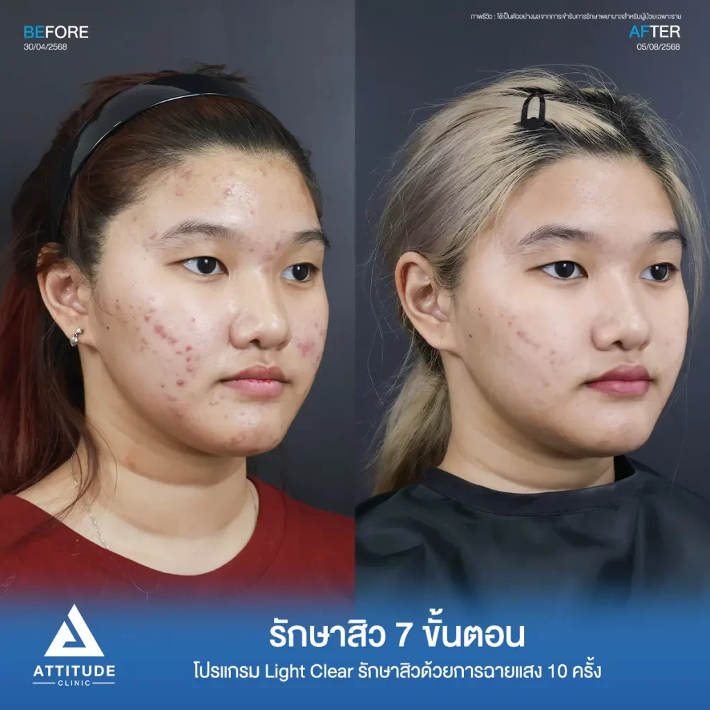 รีวิวรักษาสิวพี่เอ็ม โปรแกรม Light Clear รักษาสิวด้วยการฉายแสง จำนวน 10 ครั้งที่ Attitude Clinic