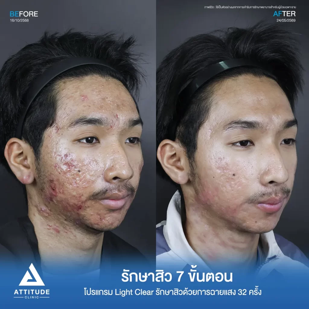 รีวิวรักษาสิวเอ็ม โปรแกรม Light Clear รักษาสิวด้วยการฉายแสง จำนวน 31 ครั้งที่ Attitude Clinic