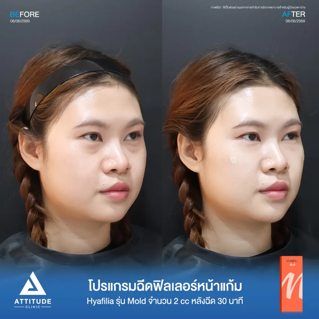 รีวิวโปรแกรมฉีดฟิลเลอร์หน้าแก้มพี่อิ๋ม Hya รุ่น Mold จำนวน 2 cc หลังทำ 30 นาที เติมเต็มใต้ตาให้สดใส ที่ ATTITUDE CLINIC