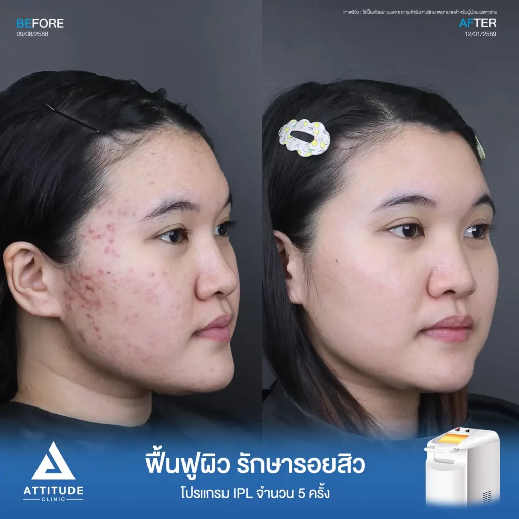 รีวิวรักษารอยสิวพี่พิมพ์ ด้วยโปรแกรม IPL จำนวน 5 ครั้ง ที่ ATTITUDE CLINIC