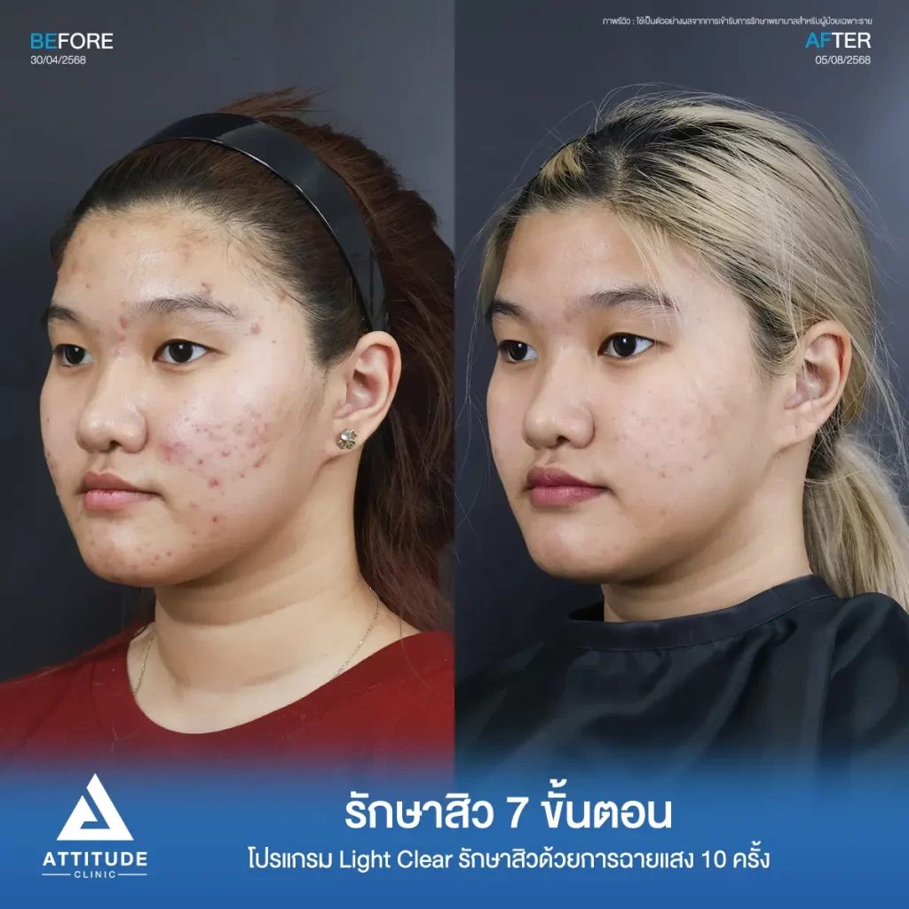 รีวิวรักษาสิวพี่เอ็ม โปรแกรม Light Clear รักษาสิวด้วยการฉายแสง จำนวน 10 ครั้งที่ Attitude Clinic