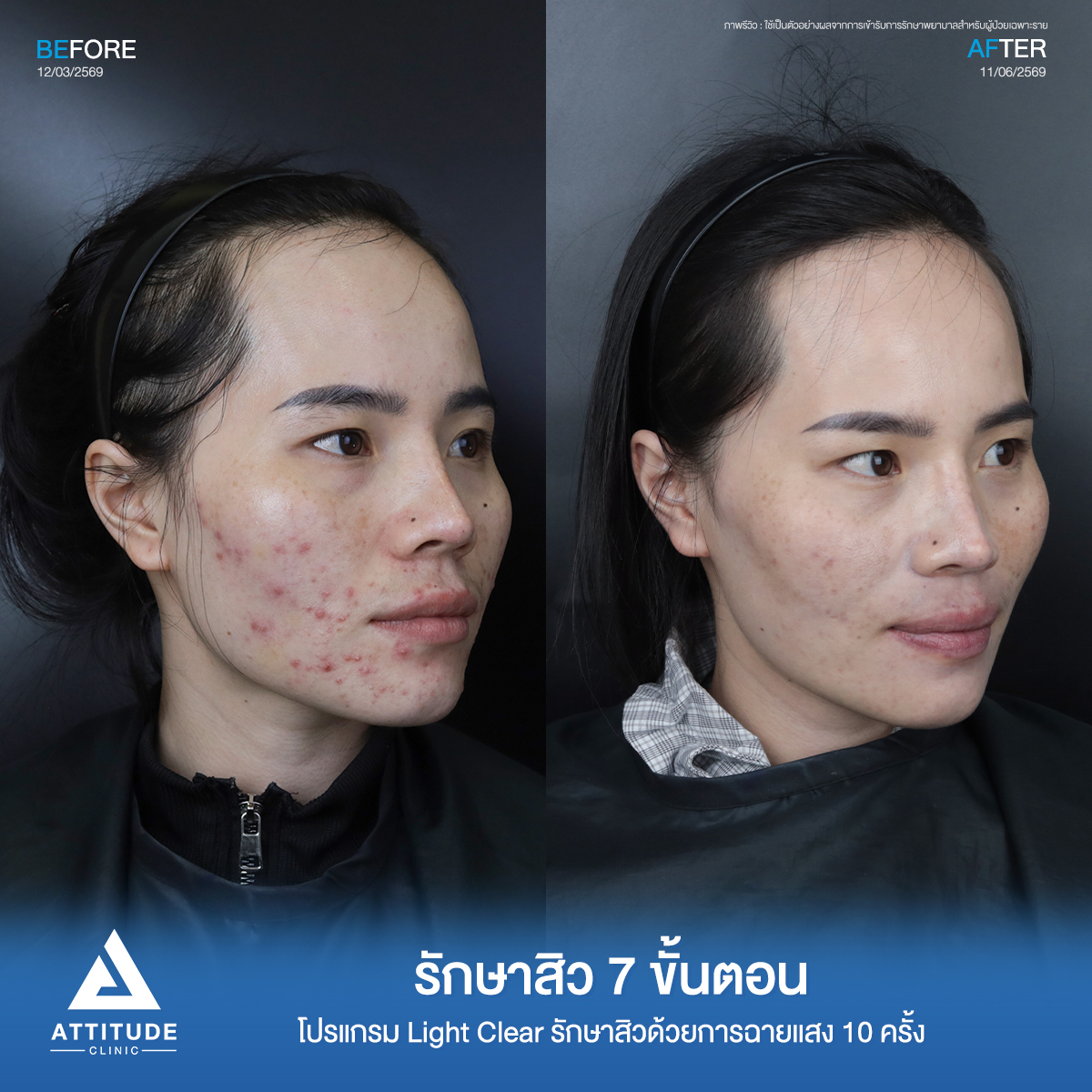 รีวิวรักษาสิวปิ่น โปรแกรม Light Clear รักษาสิวด้วยการฉายแสง จำนวน 10 ครั้งที่ Attitude Clinic