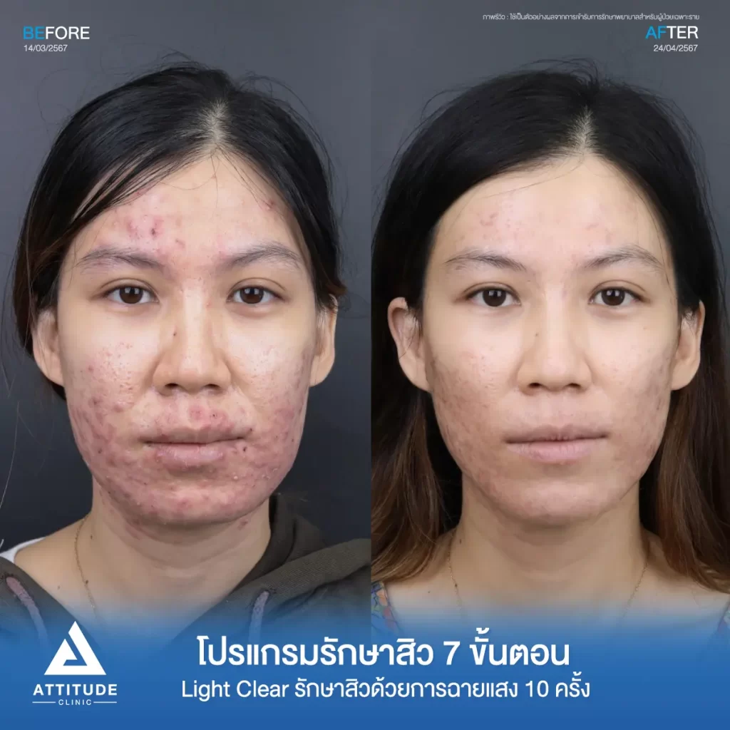 รวมรีวิวรักษาสิวอักเสบ ที่หลายคนเคยคิดว่า... "สิวแบบนี้รักษายาก"