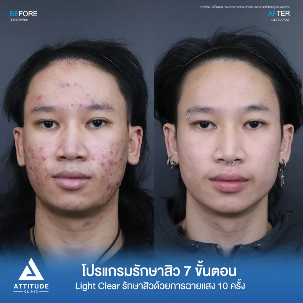 รวมรีวิวรักษาสิวอักเสบ ที่หลายคนเคยคิดว่า... "สิวแบบนี้รักษายาก"
