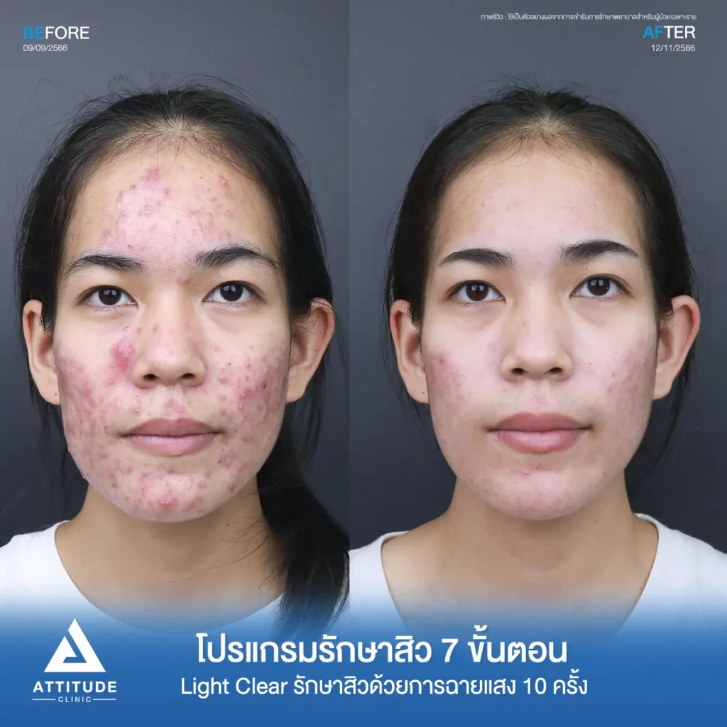 รวมรีวิวรักษาสิวอักเสบ ที่หลายคนเคยคิดว่า... "สิวแบบนี้รักษายาก"