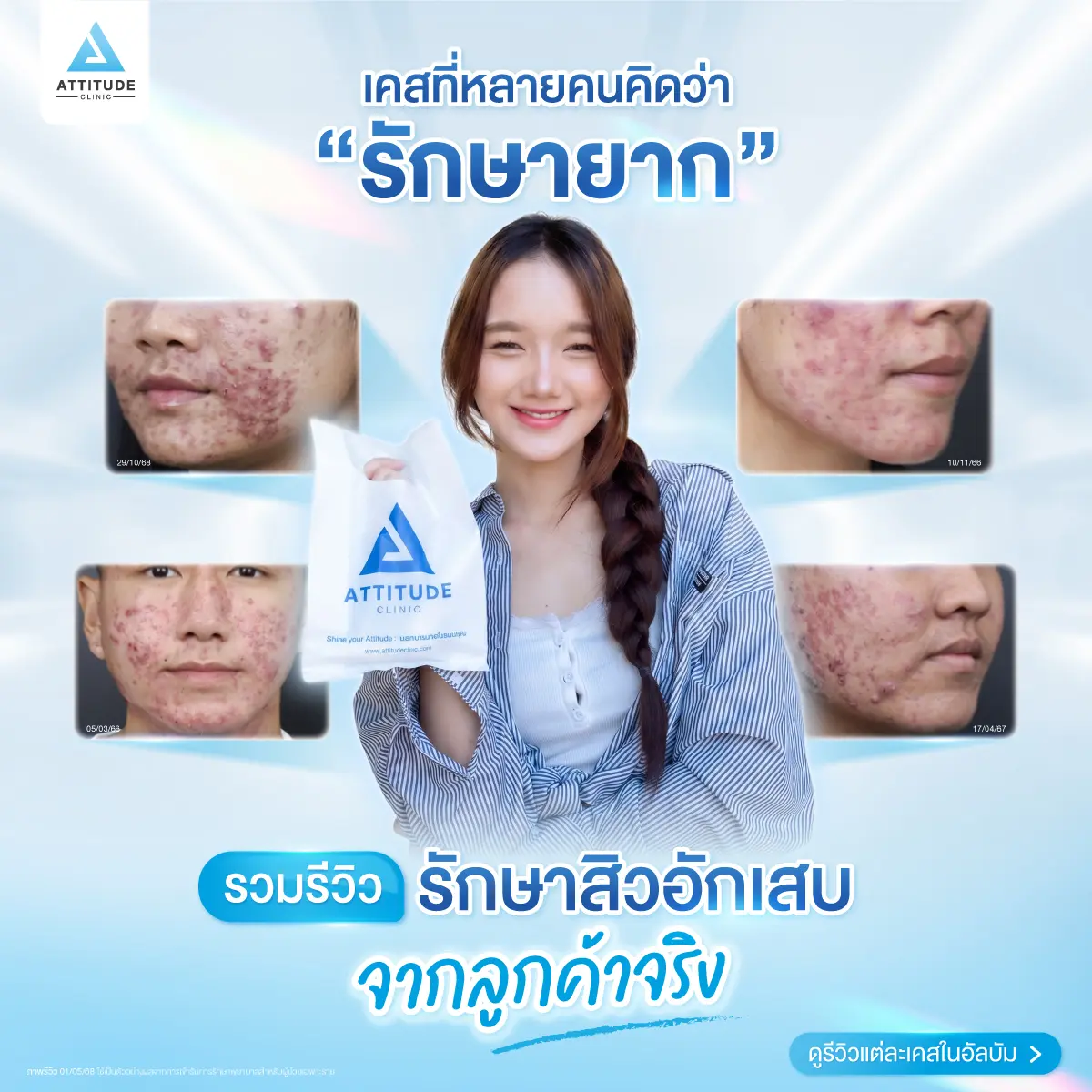 รวมรีวิวรักษาสิวอักเสบ ที่หลายคนเคยคิดว่า... "สิวแบบนี้รักษายาก"