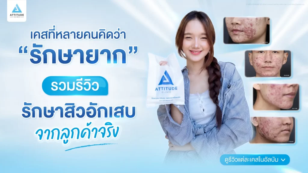 รวมรีวิวรักษาสิวอักเสบ ที่หลายคนเคยคิดว่า... "สิวแบบนี้รักษายาก"