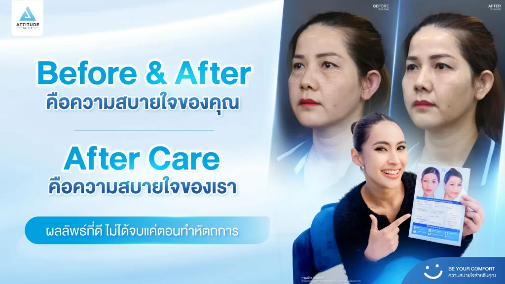 โปรแกรมฉีดฟิลเลอร์ที่ Attitude Clinic เราไม่ได้ Care แค่ผลลัพธ์