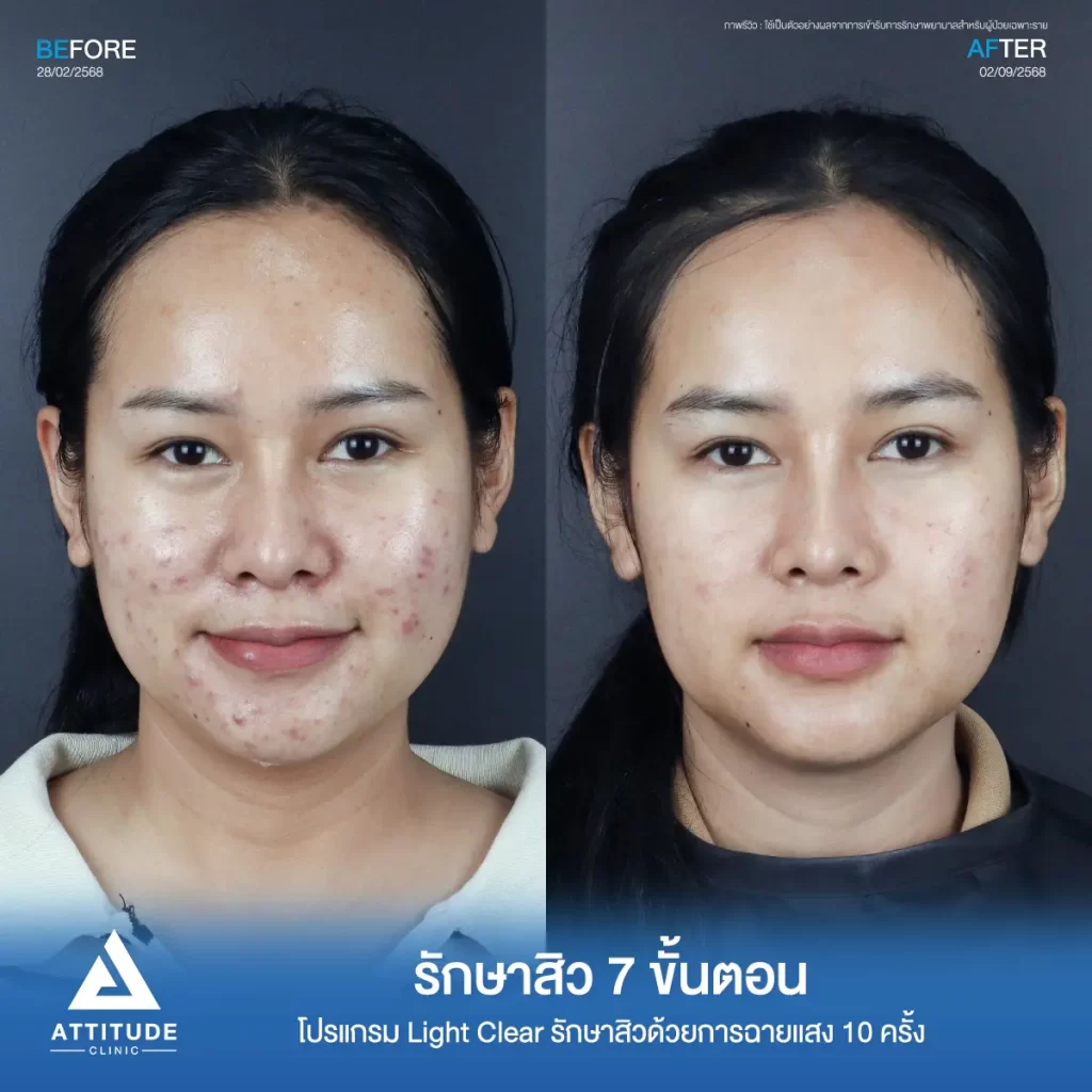รวมรีวิวรักษาสิวอักเสบ ที่หลายคนเคยคิดว่า... "สิวแบบนี้รักษายาก"