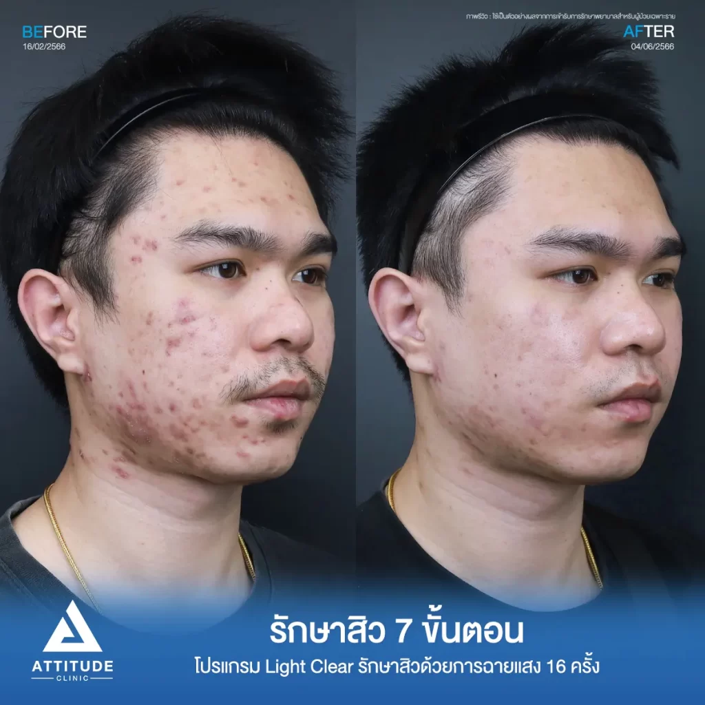 รวมรีวิวรักษาสิวอักเสบ ที่หลายคนเคยคิดว่า... "สิวแบบนี้รักษายาก"