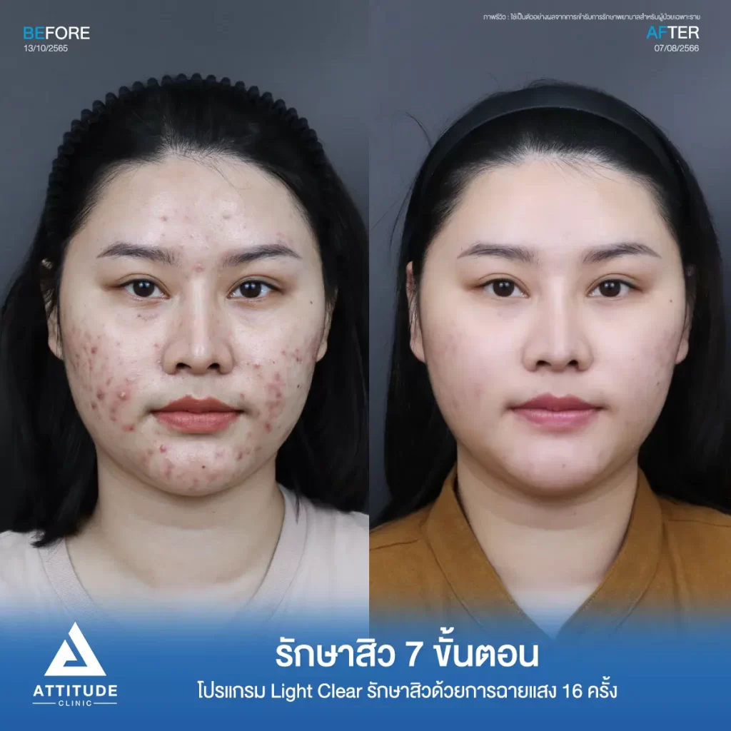 รวมรีวิวรักษาสิวอักเสบ ที่หลายคนเคยคิดว่า... "สิวแบบนี้รักษายาก"