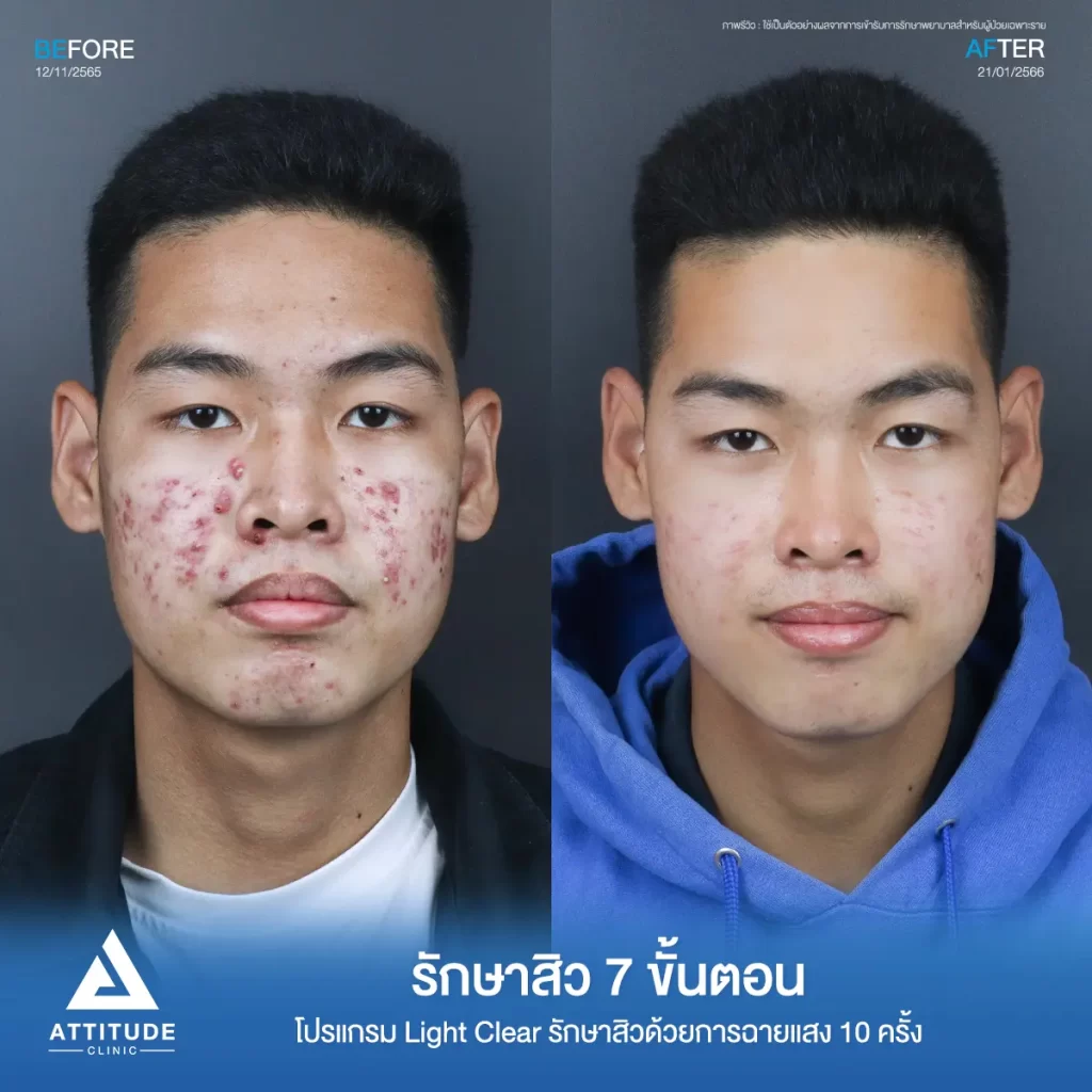 รวมรีวิวรักษาสิวอักเสบ ที่หลายคนเคยคิดว่า... "สิวแบบนี้รักษายาก"
