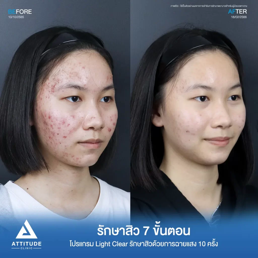 รวมรีวิวรักษาสิวอักเสบ ที่หลายคนเคยคิดว่า... "สิวแบบนี้รักษายาก"